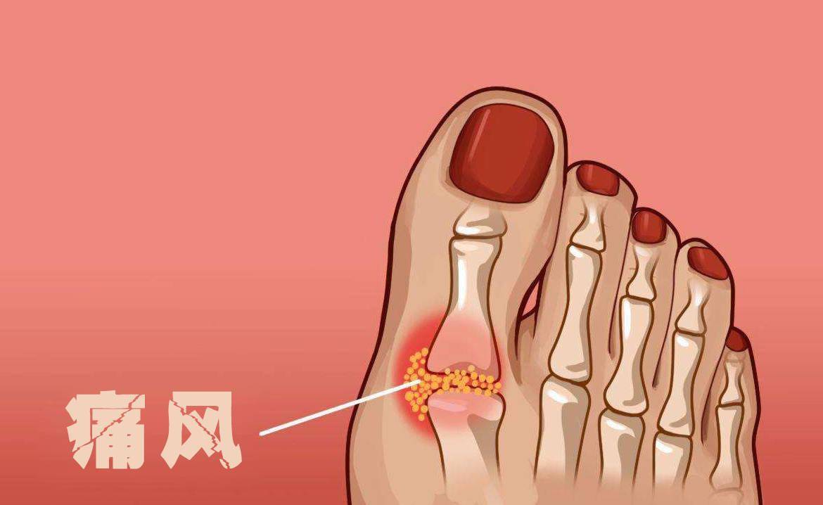 痛风病症状 痛风有哪些什么症状