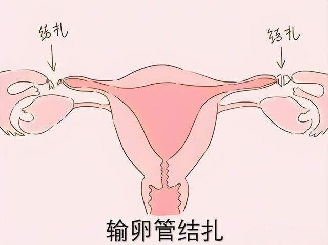 女人结扎了还能恢复生孩子吗 女人结扎了还可以恢复生育能力吗